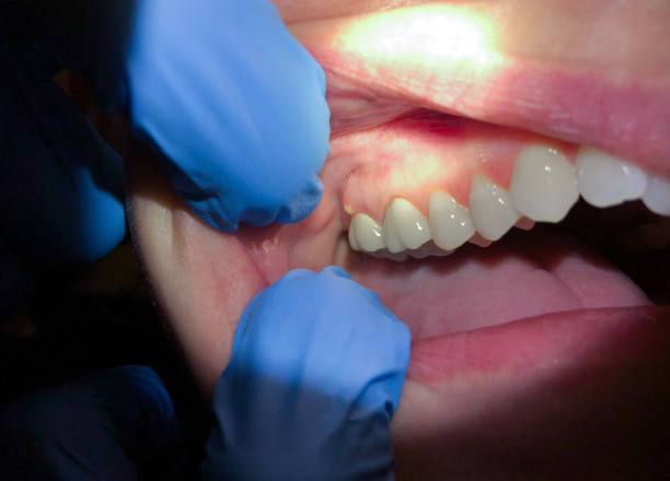 Best Emergency Dental Filling Replacement  in New Wilmington, PA